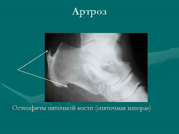 Артроз Остеофиты пяточной кости ( «пяточная шпора» ) 