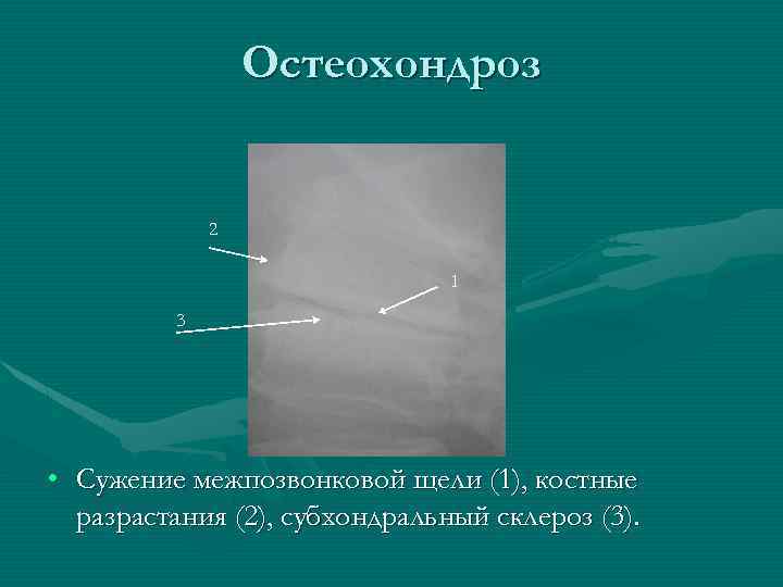 Остеохондроз 2 1 3 • Сужение межпозвонковой щели (1), костные разрастания (2), субхондральный склероз