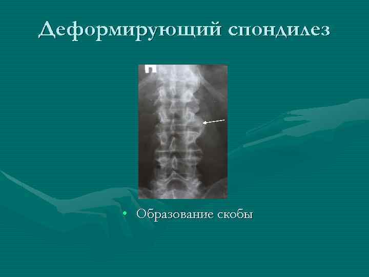 Деформирующий спондилез • Образование скобы 