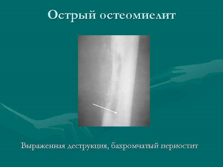 Острый остеомиелит Выраженная деструкция, бахромчатый периостит 