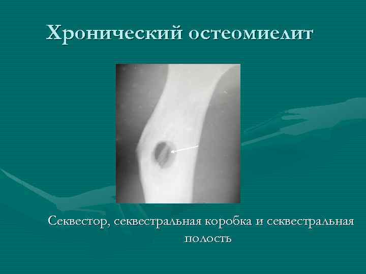 Хронический остеомиелит Секвестор, секвестральная коробка и секвестральная полость 