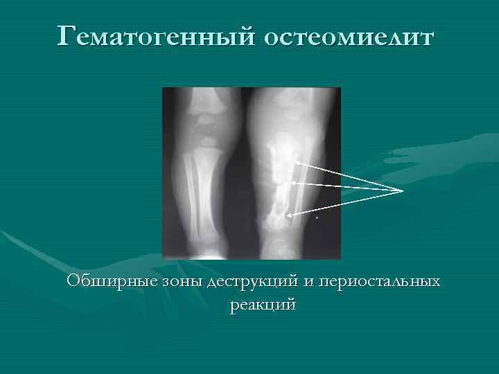 Гематогенный остеомиелит Обширные зоны деструкций и периостальных реакций 