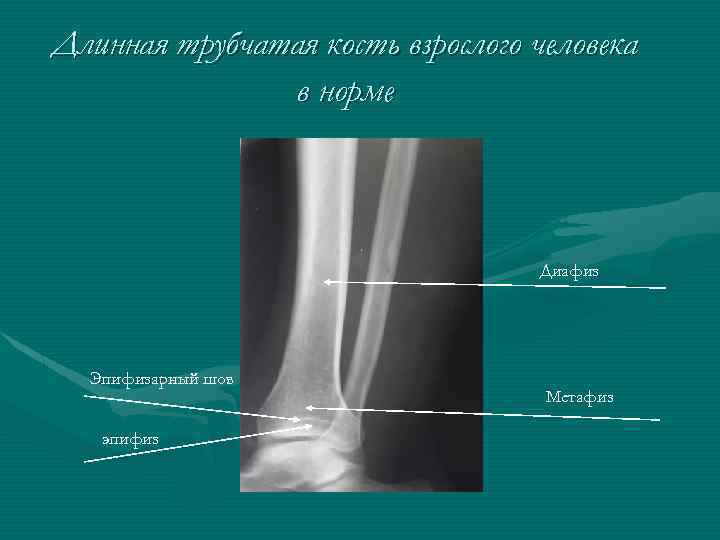 Длинная трубчатая кость взрослого человека в норме Диафиз Эпифизарный шов эпифиз Метафиз 