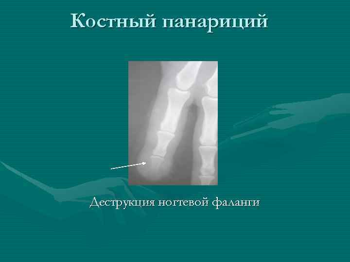 Костный панариций Деструкция ногтевой фаланги 