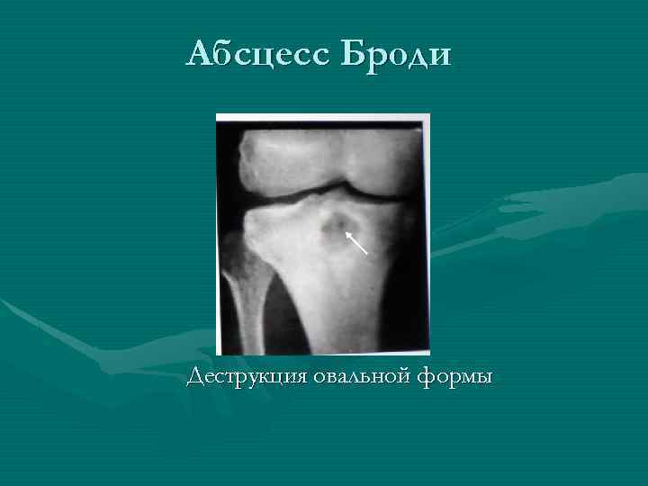 Абсцесс Броди Деструкция овальной формы 
