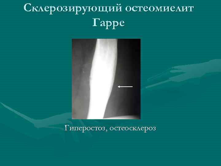 Склерозирующий остеомиелит Гарре Гиперостоз, остеосклероз 