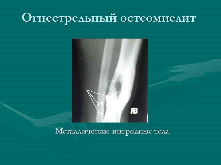 Огнестрельный остеомиелит Металлические инородные тела 