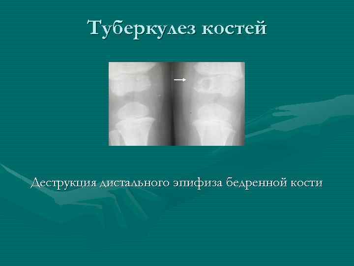 Туберкулез костей Деструкция дистального эпифиза бедренной кости 
