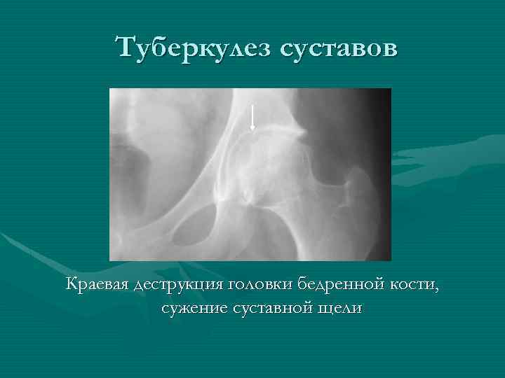 Туберкулез суставов Краевая деструкция головки бедренной кости, сужение суставной щели 