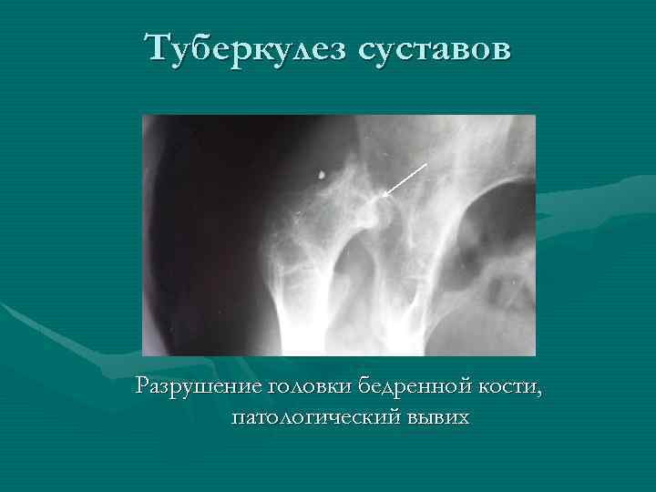 Туберкулез суставов Разрушение головки бедренной кости, патологический вывих 