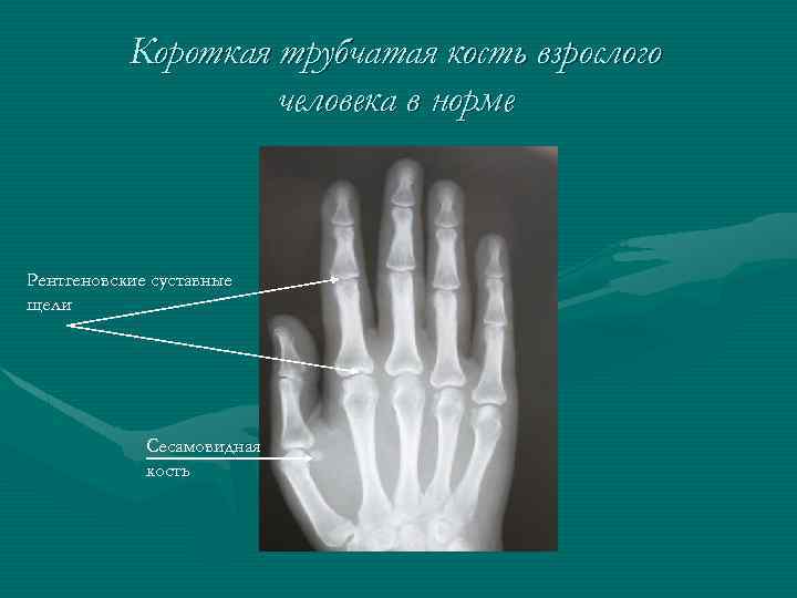 Короткая трубчатая кость взрослого человека в норме Рентгеновские суставные щели Сесамовидная кость 