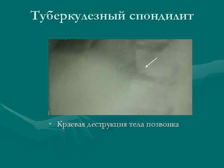 Туберкулезный спондилит • Краевая деструкция тела позвонка 