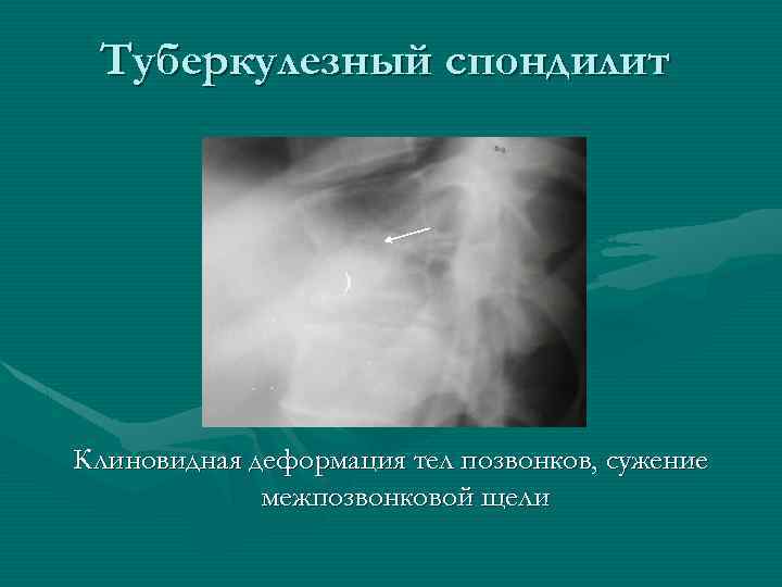 Туберкулезный спондилит Клиновидная деформация тел позвонков, сужение межпозвонковой щели 