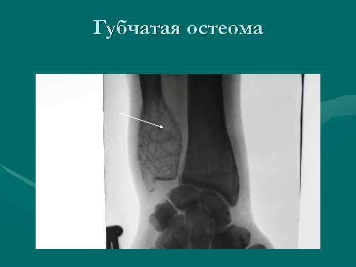 Губчатая остеома 
