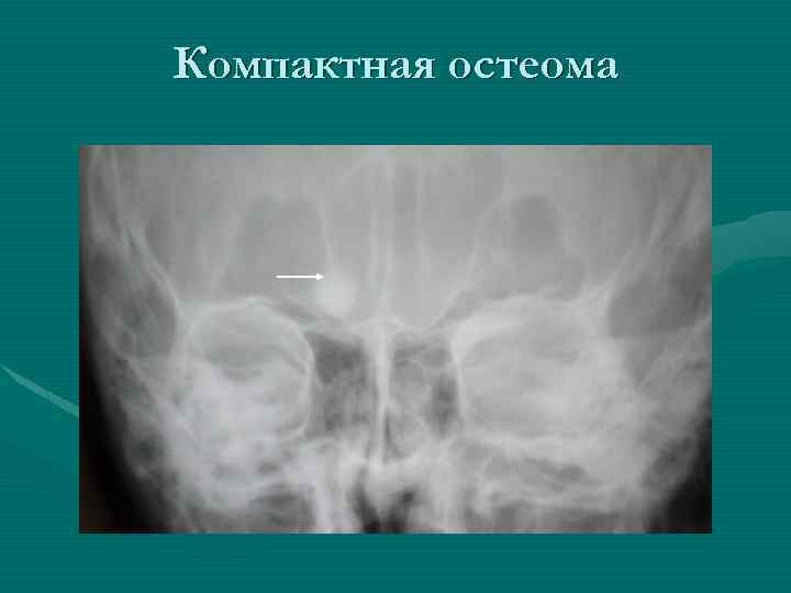Компактная остеома 