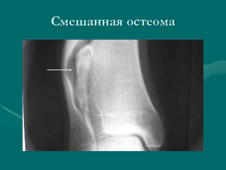 Смешанная остеома 