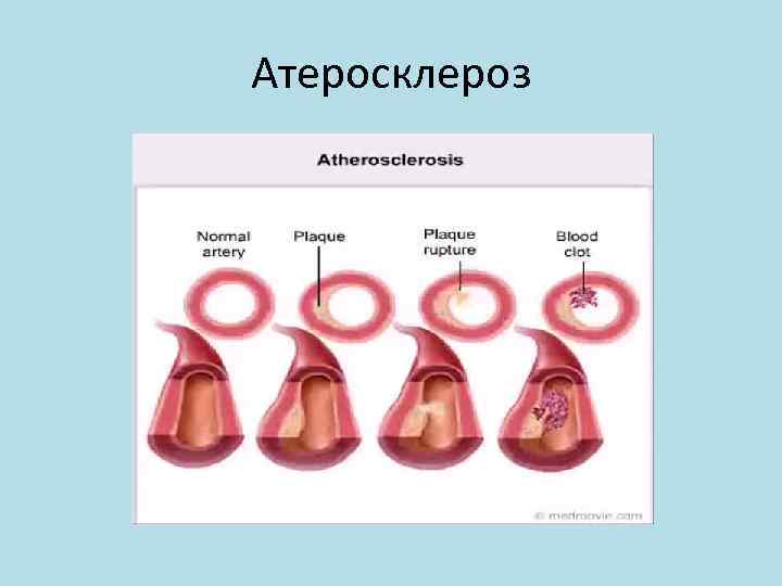 Атеросклероз 