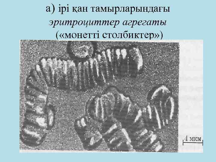 а) ірі қан тамырларындағы эритроциттер агрегаты ( «монетті столбиктер» ) 