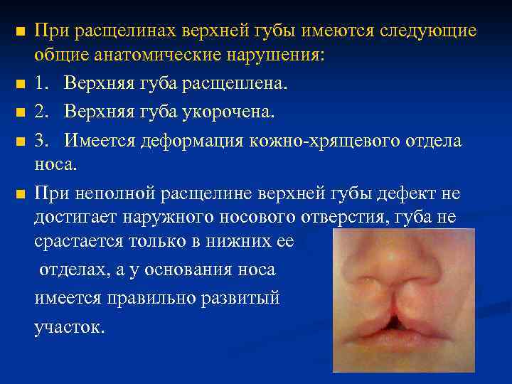 n n n При расщелинах верхней губы имеются следующие общие анатомические нарушения: 1. Верхняя