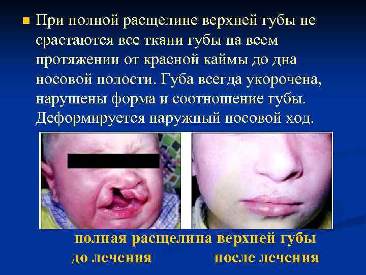 n При полной расщелине верхней губы не срастаются все ткани губы на всем протяжении