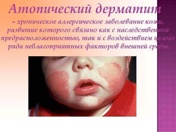 Атопический дерматит – хроническое аллергическое заболевание кожи, развитие которого связано как с наследственной предрасположенностью,