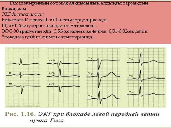 Гис шоғырының сол жақ аяқшасының алдыңғы тармақтың блокадасы ЭКГ диагностикасы: Биіктеген R тісшесі I,