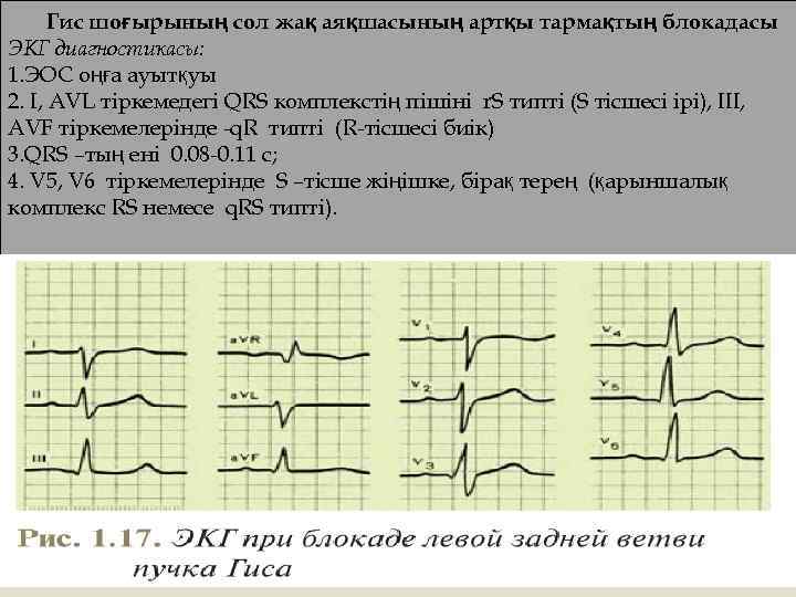 Гис шоғырының сол жақ аяқшасының артқы тармақтың блокадасы ЭКГ диагностикасы: 1. ЭОС оңға ауытқуы