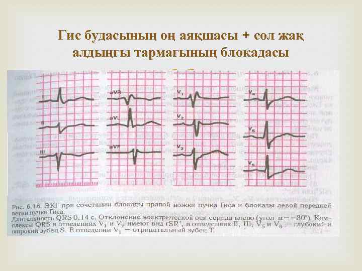 Гис будасының оң аяқшасы + сол жақ алдыңғы тармағының блокадасы 