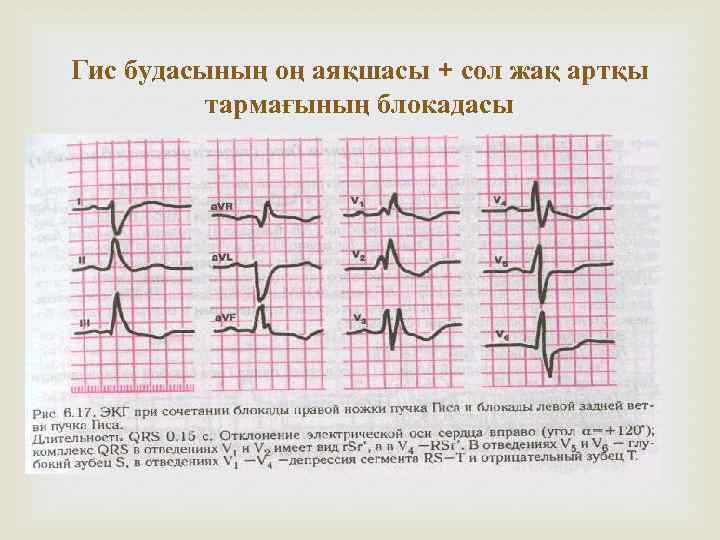 Гис будасының оң аяқшасы + сол жақ артқы тармағының блокадасы 