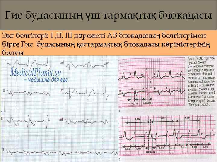 Гис будасының үш тармақтық блокадасы Экг белгілері: I , III дәрежелі АВ блокаданың белгілерімен