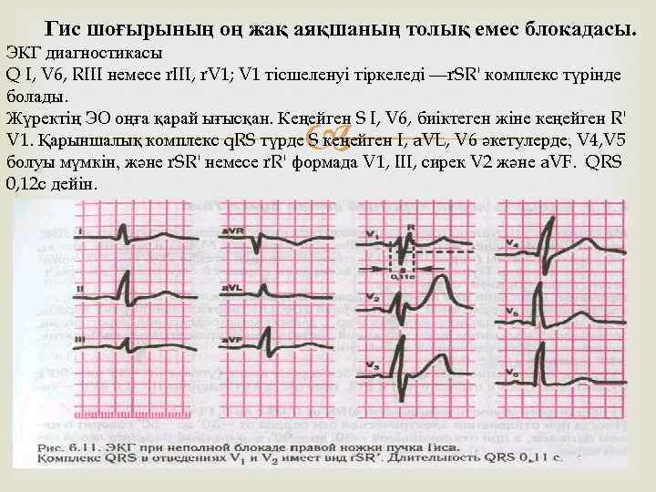 Гис шоғырының оң жақ аяқшаның толық емес блокадасы. ЭКГ диагностикасы Q I, V 6,