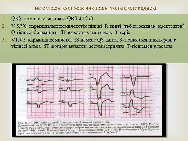 Гис будасы сол жақ аяқшасы толық блокадасы 1. 2. 3. QRS комплексі жалпақ (QRS