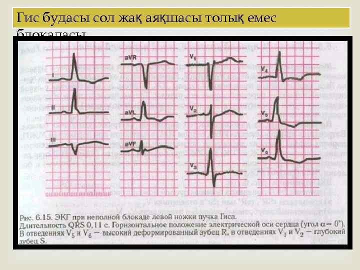 Гис будасы сол жақ аяқшасы толық емес блокадасы 