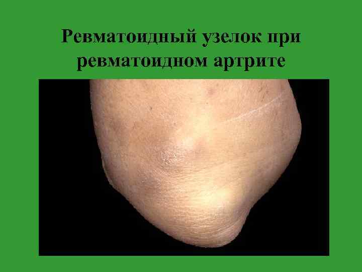 Ревматоидный узелок при ревматоидном артрите 