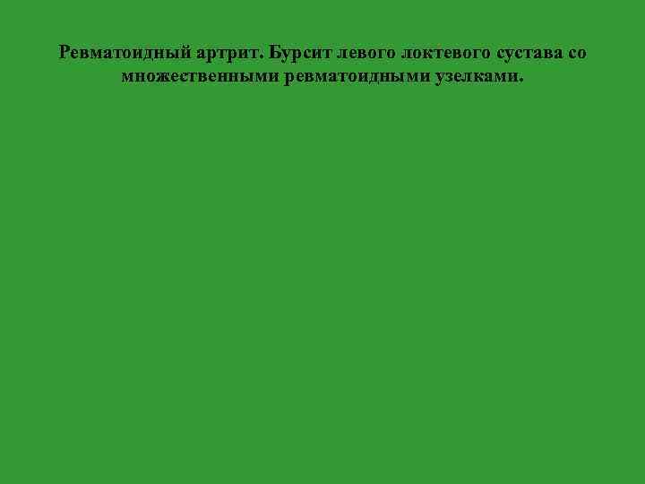 Ревматоидный артрит. Бурсит левого локтевого сустава со множественными ревматоидными узелками. 
