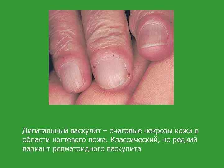 Дигитальный васкулит – очаговые некрозы кожи в области ногтевого ложа. Классический, но редкий вариант