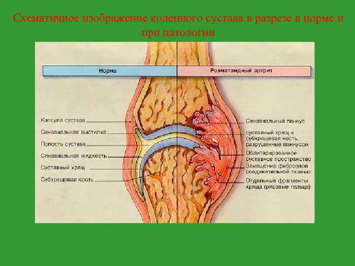 Схематичное изображение коленного сустава в разрезе в норме и при патологии 