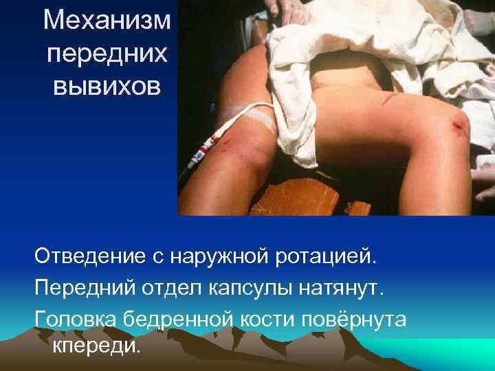 Механизм передних вывихов Отведение с наружной ротацией. Передний отдел капсулы натянут. Головка бедренной кости
