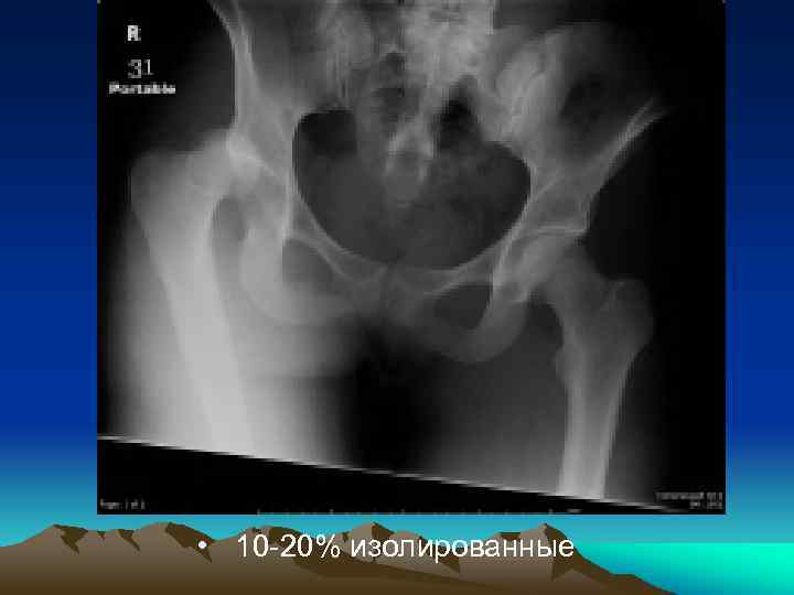  • 10 -20% изолированные 