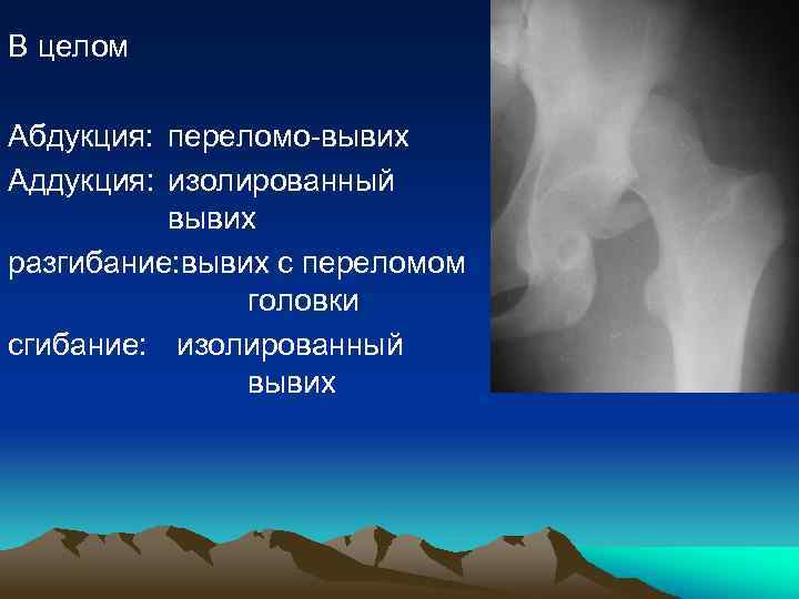 В целом Абдукция: переломо-вывих Аддукция: изолированный вывих разгибание: вывих с переломом головки сгибание: изолированный