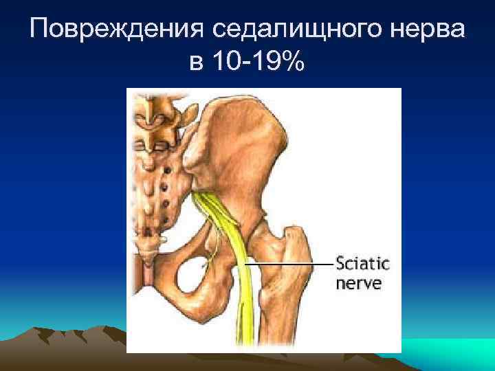 Повреждения седалищного нерва в 10 -19% 
