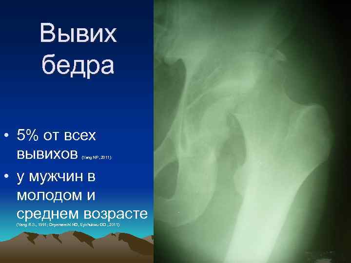 Вывих бедра • 5% от всех вывихов • у мужчин в молодом и среднем