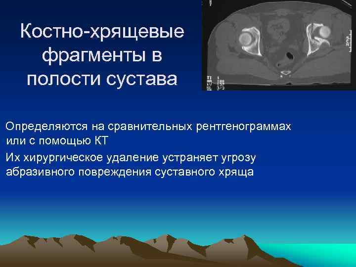 Костно-хрящевые фрагменты в полости сустава Определяются на сравнительных рентгенограммах или с помощью КТ Их