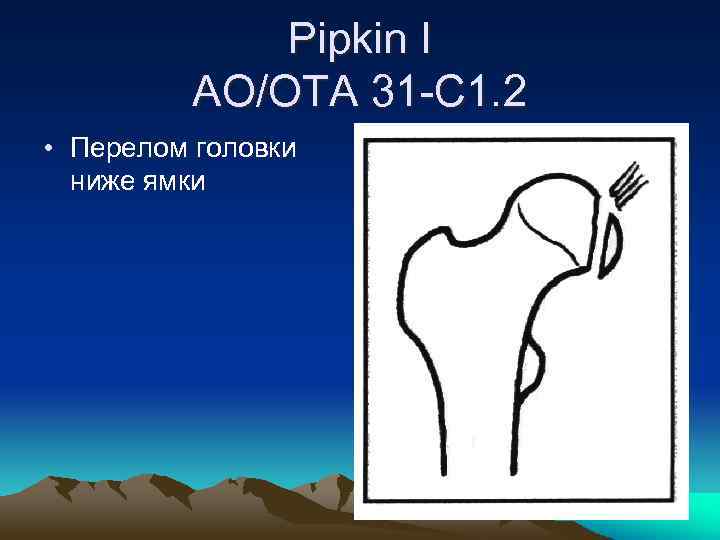 Pipkin I AO/OTA 31 -C 1. 2 • Перелом головки ниже ямки 