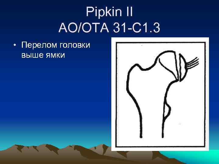 Pipkin II AO/OTA 31 -C 1. 3 • Перелом головки выше ямки 