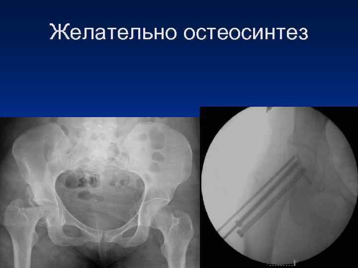 Желательно остеосинтез 