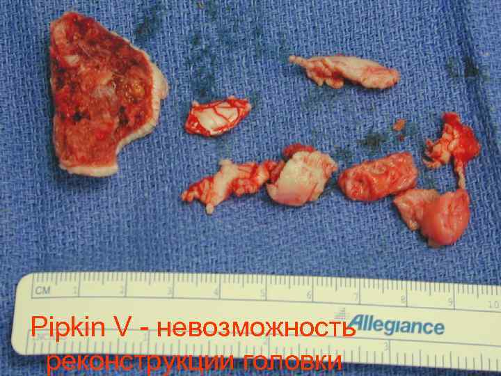 Pipkin V - невозможность реконструкции головки 