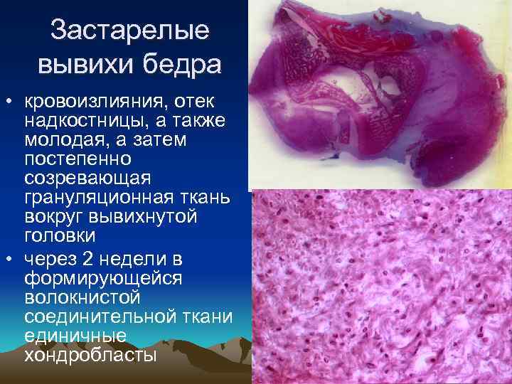 Застарелые вывихи бедра • кровоизлияния, отек надкостницы, а также молодая, а затем постепенно созревающая