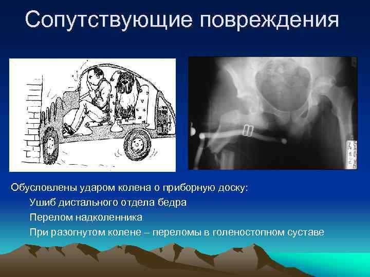 Врожденный вывих бедра презентация травматология