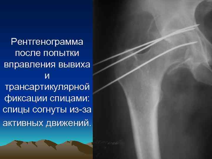 Рентгенограмма после попытки вправления вывиха и трансартикулярной фиксации спицами: спицы согнуты из-за активных движений.